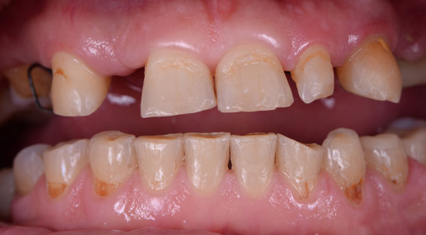 dental implants before