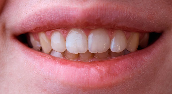 invisalign after