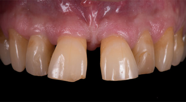 porcelain veneers before