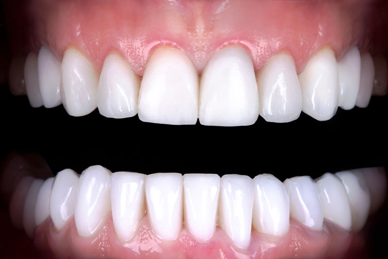 close up of before and after dental procedure