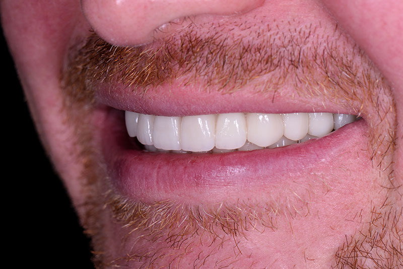 close up of before and after dental procedure