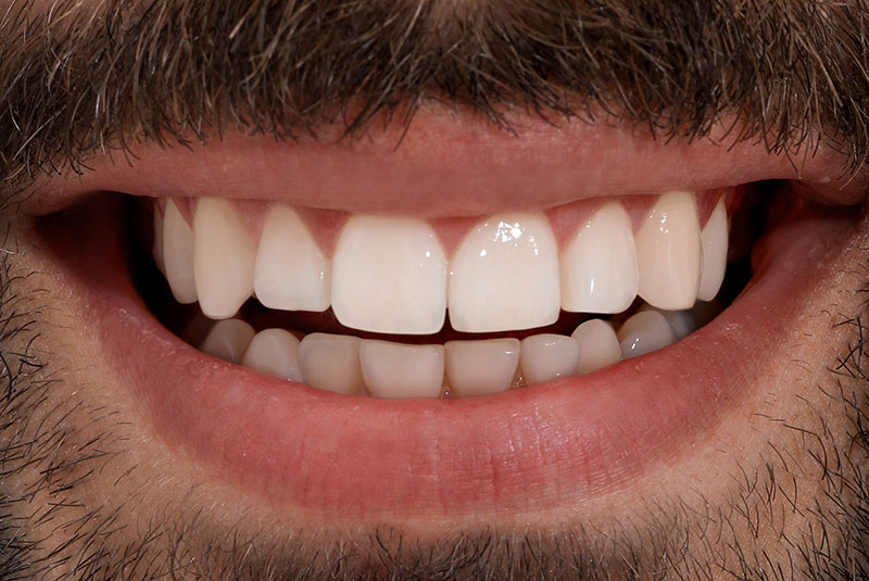 close up of before and after dental procedure