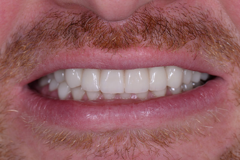 close up of before and after dental procedure