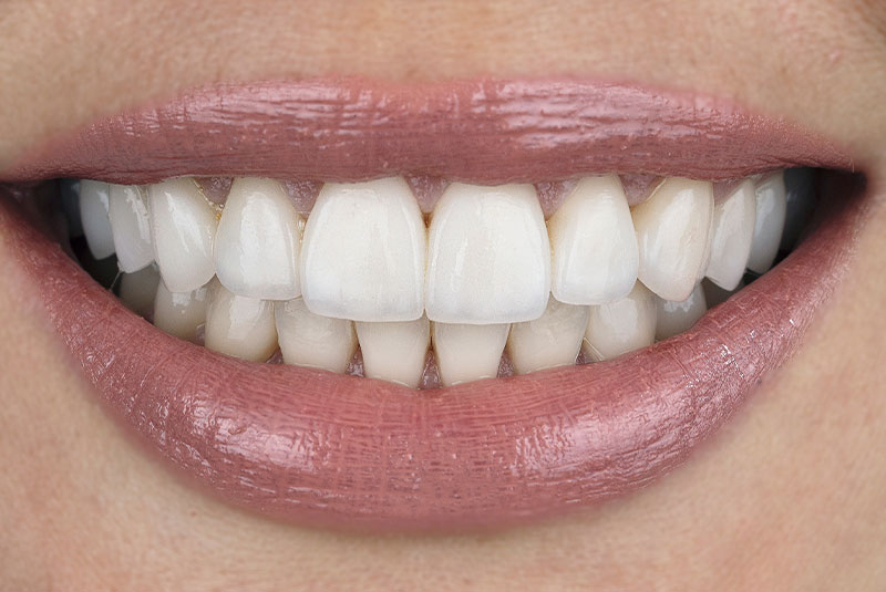 close up of before and after dental procedure