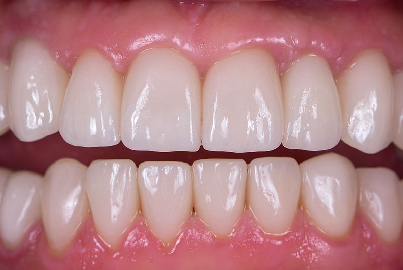 close up of before and after dental procedure