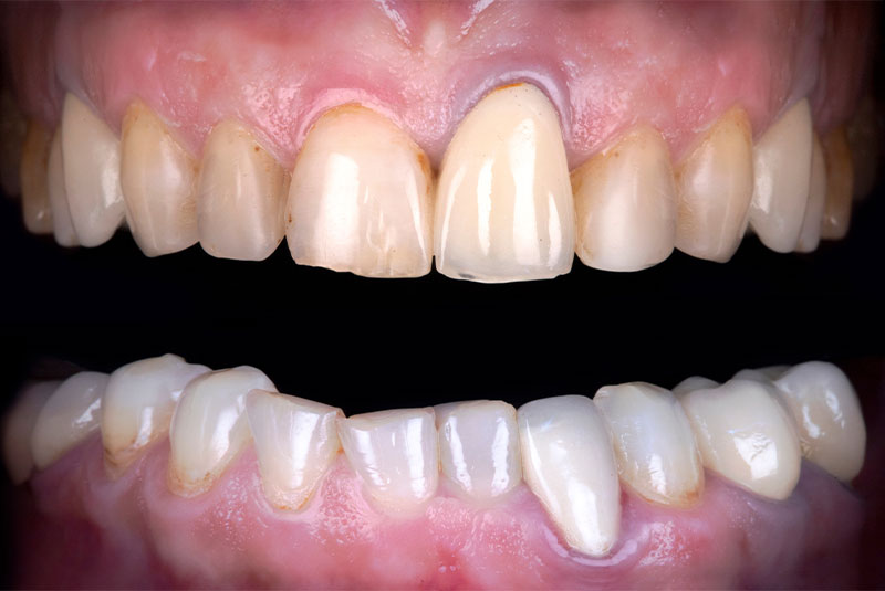 close up of before and after dental procedure