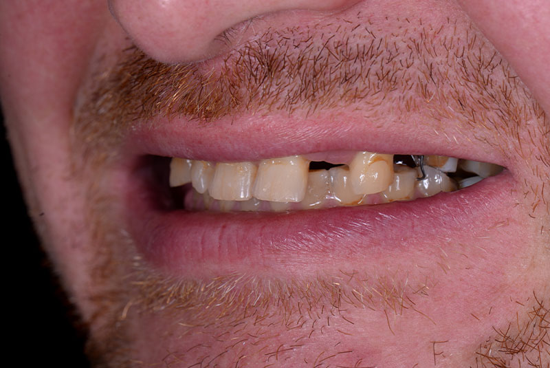 close up of before and after dental procedure