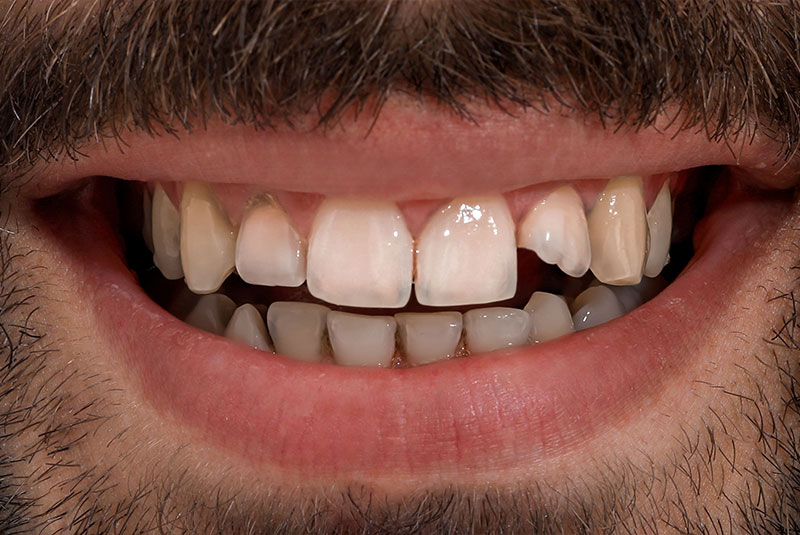 close up of before and after dental procedure