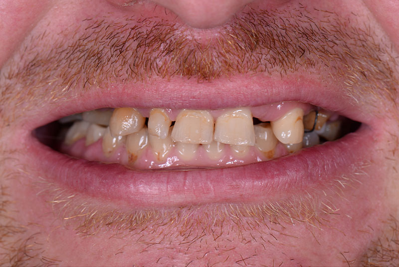 close up of before and after dental procedure