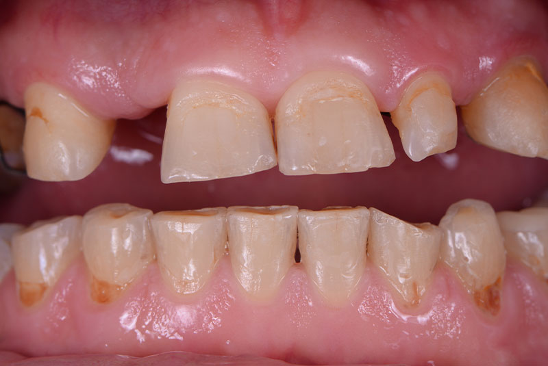 close up of before and after dental procedure