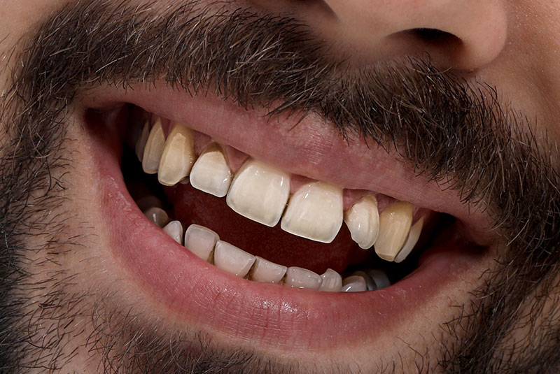 close up of before and after dental procedure