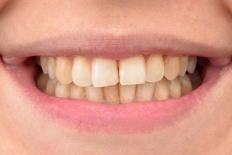 close up of before and after dental procedure