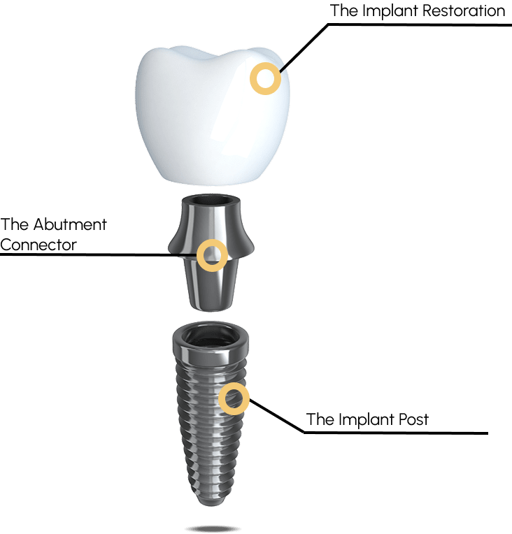 Dental Implant post with three info points