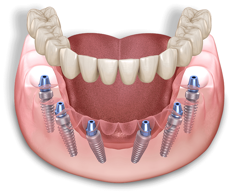 Illustration of dental implant full arch model
