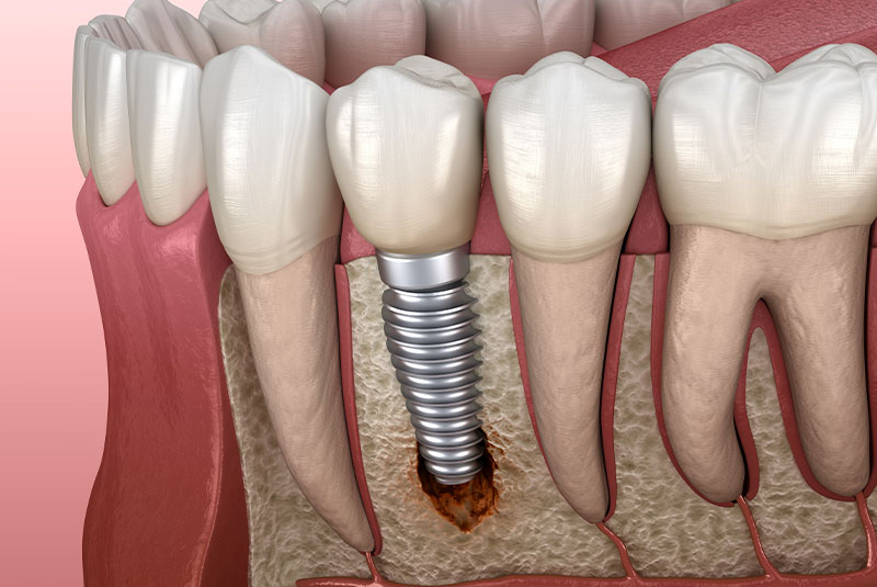 peri-Implantitis