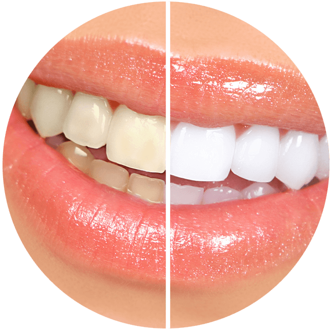 before and after results of teeth whitening