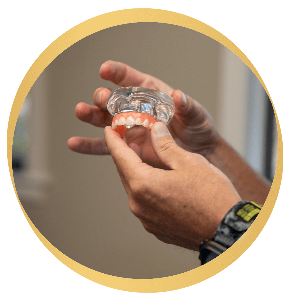 model of full arch implants