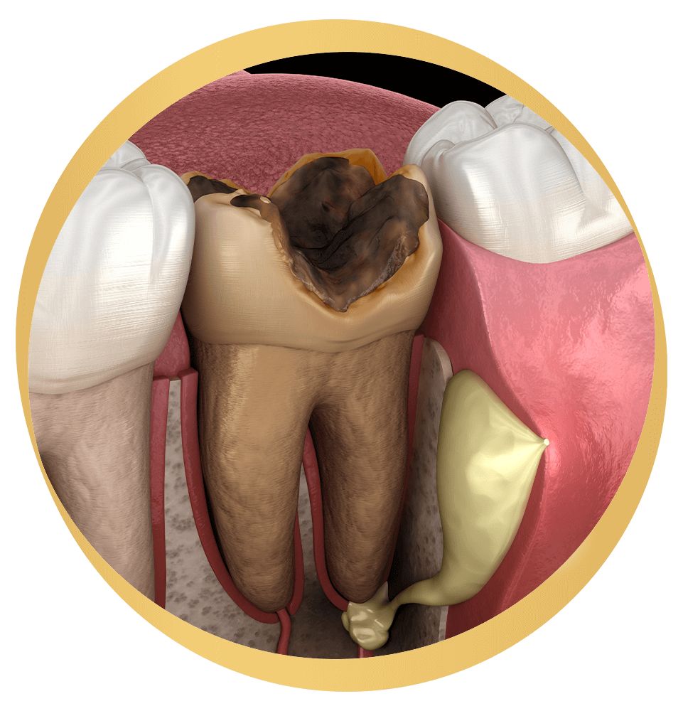 Tooth abscess